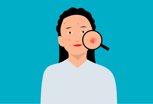 cbd oil for acne - zen bliss